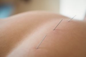 Rückenschmerzen, Akupunktur-Therapie