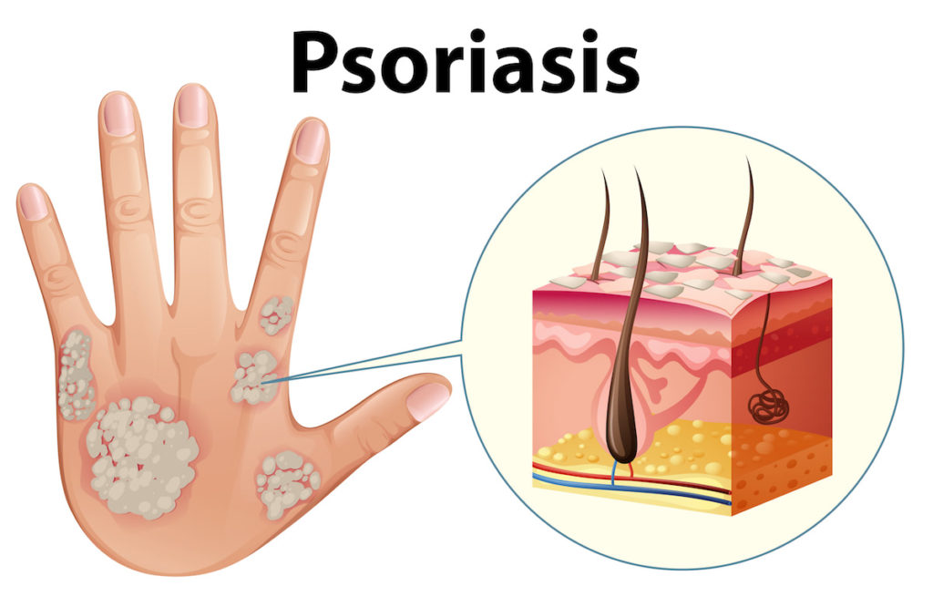 Psoriasis: Where does it occur?