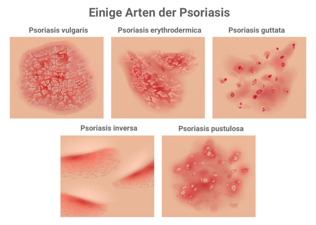 Psoriasis - what are the types?
