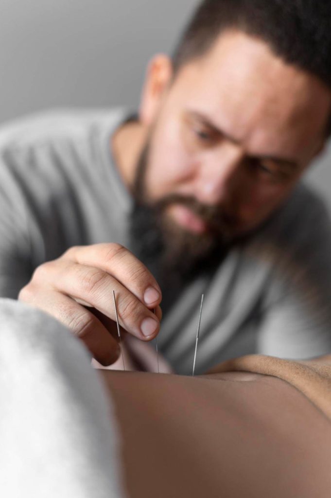 Acupuncture for pain and discomfort relief in fibromyalgia (FMS).