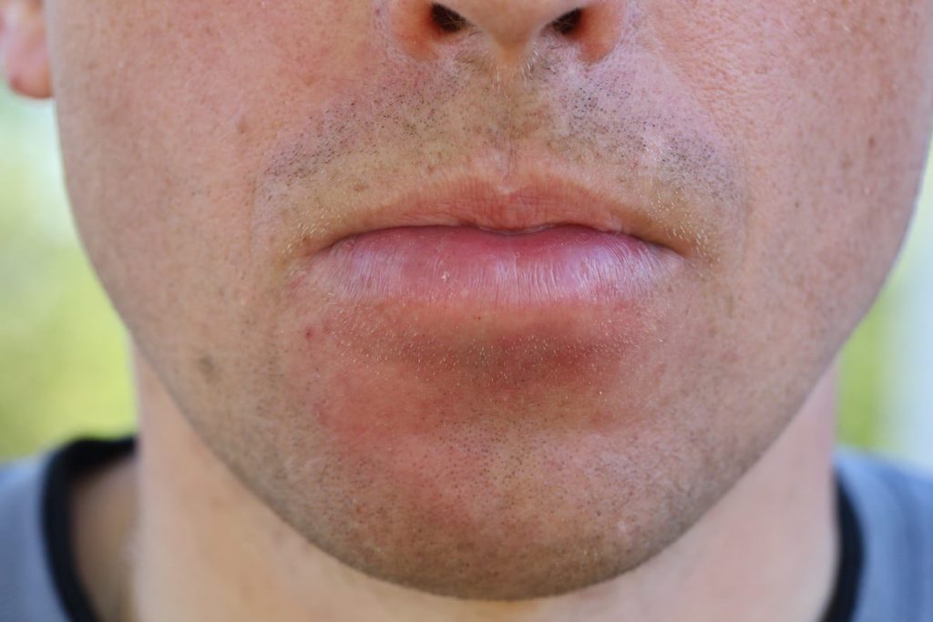 Angioedema, a sudden and painful swelling of the deeper layers of the skin.