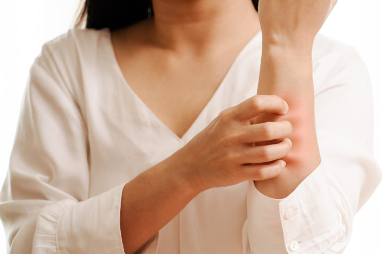 Nesselsucht - Frau hat starken Juckreiz und kratzt sich am Arm