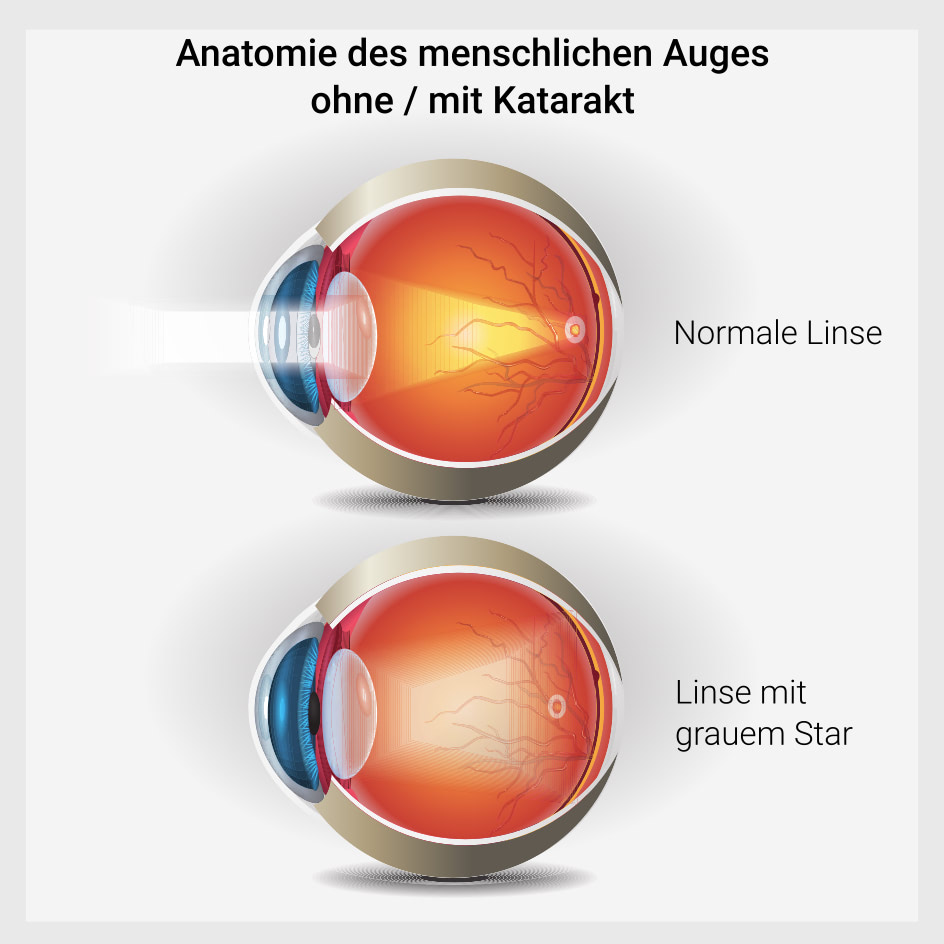 Anatomie des menschlichen Auges ohne und mit grauem Star (Katarakt)
