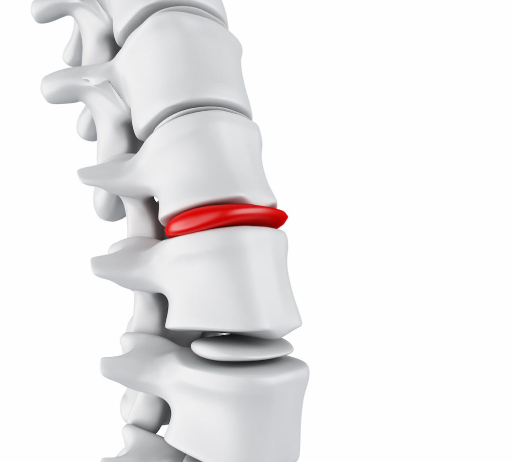 Pain and restricted movement as a result of a herniated disc