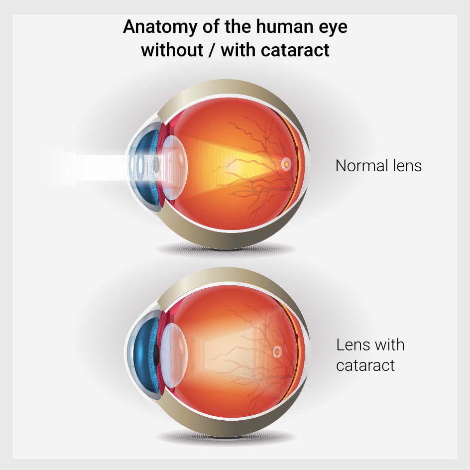 Anatomy of the human eye without_with cataract