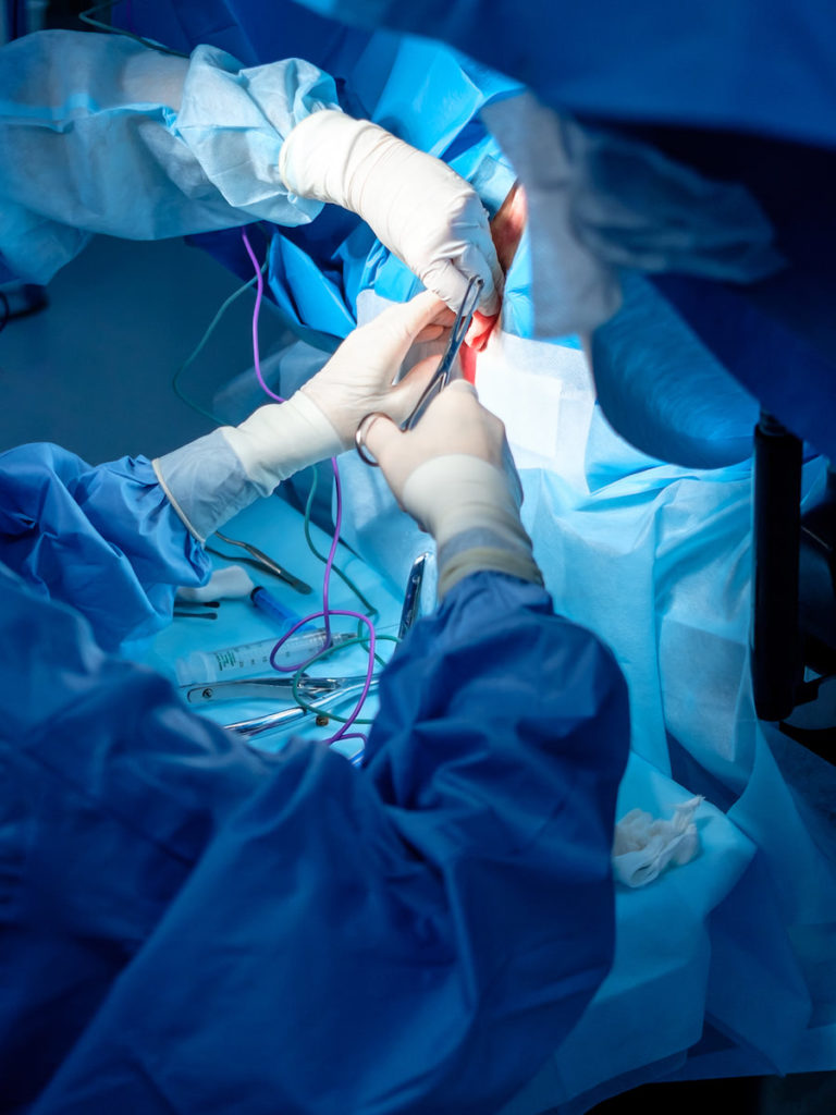 Bowel surgery for ulcerative colitis