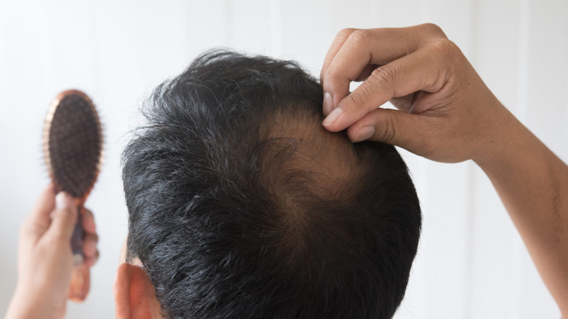 Alopecia - What you can do against hair loss
