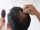 Alopecia - What you can do against hair loss
