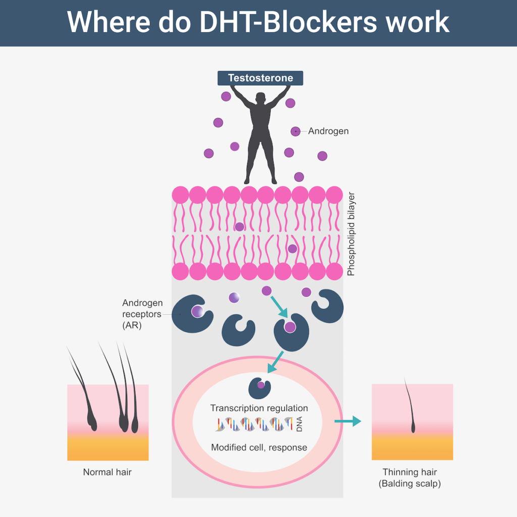 Alopecia - Where do DHT-blockers work