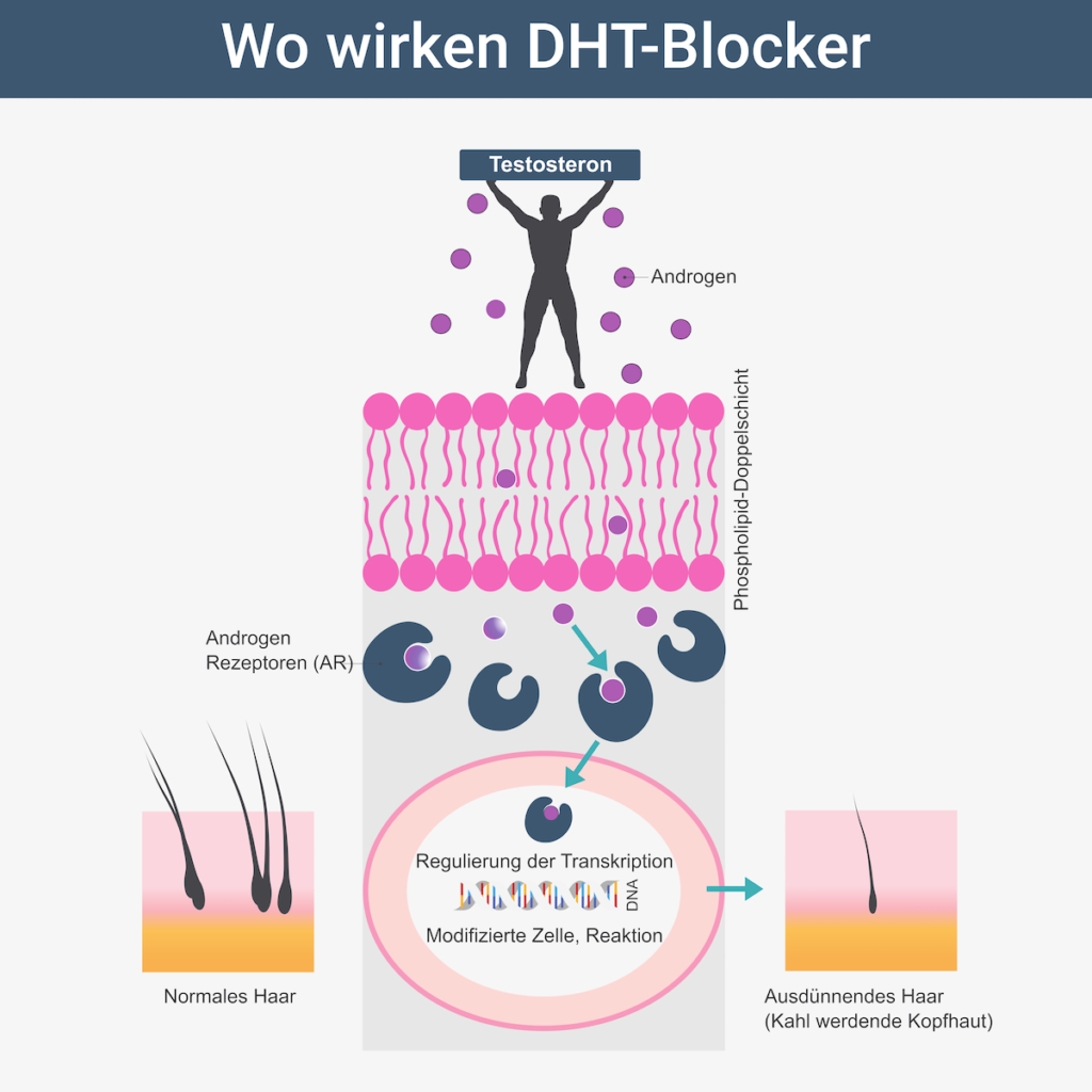 Alopezie - Wo wirken DHT-Blocker