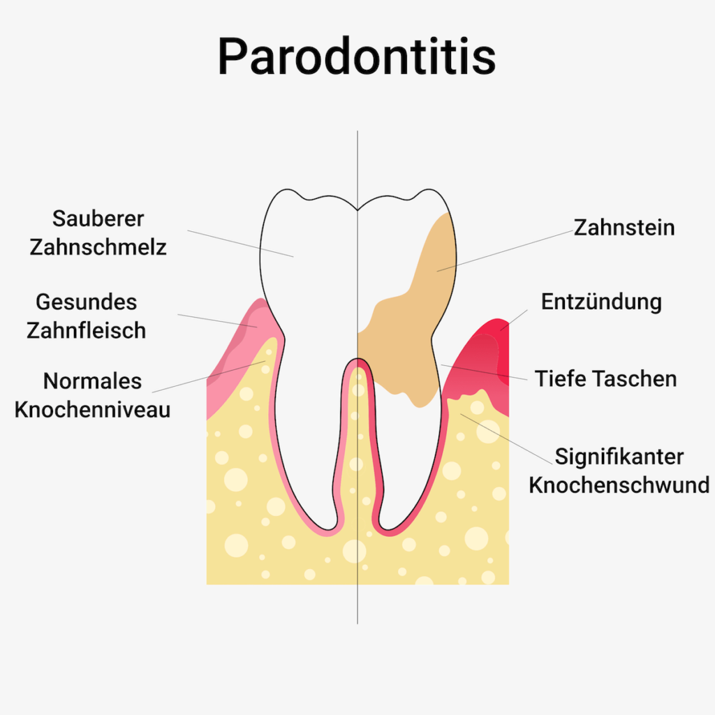 Wie erkennt man Parodontitis (Parodontose)