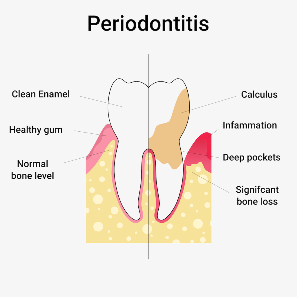 How to recognise periodontitis (Periodontosis)