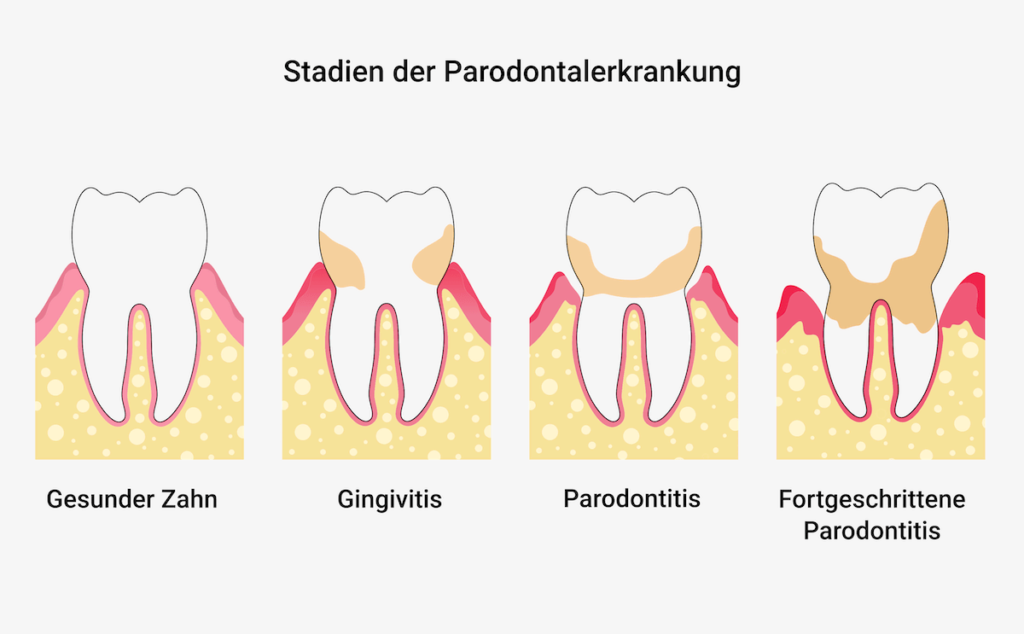 Stadien der Parodontitis (Parodontose)