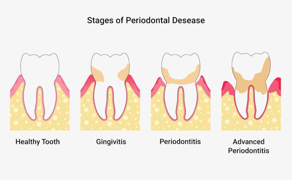Stages of periodontitis (Periodontosis)